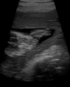 4-Dimensional Ultrasound